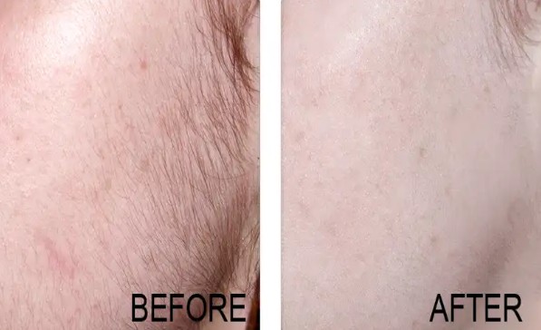 Stretch Mark Laser Removal Brooklyn NY