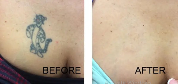 Acne Scar Laser Treatment Brooklyn NY