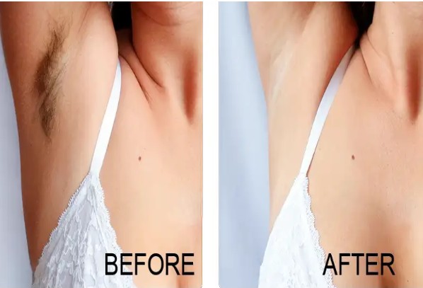 Laser Hair Removal Brooklyn NY