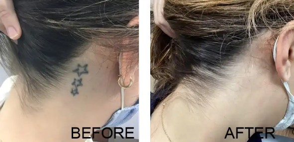 Laser Tattoo Removal Brooklyn NY