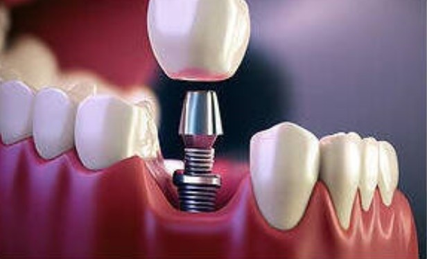 North Miami Beach Dental Implants